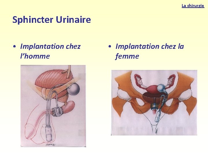 La chirurgie Sphincter Urinaire • Implantation chez l’homme • Implantation chez la femme 