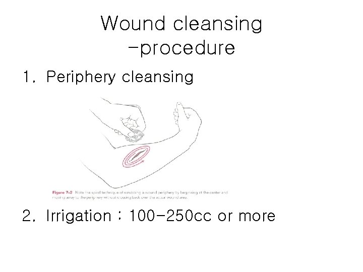 Wound cleansing -procedure 1. Periphery cleansing 2. Irrigation : 100 -250 cc or more Wound cleansing -procedure 1. Periphery cleansing 2. Irrigation : 100 -250 cc or more
