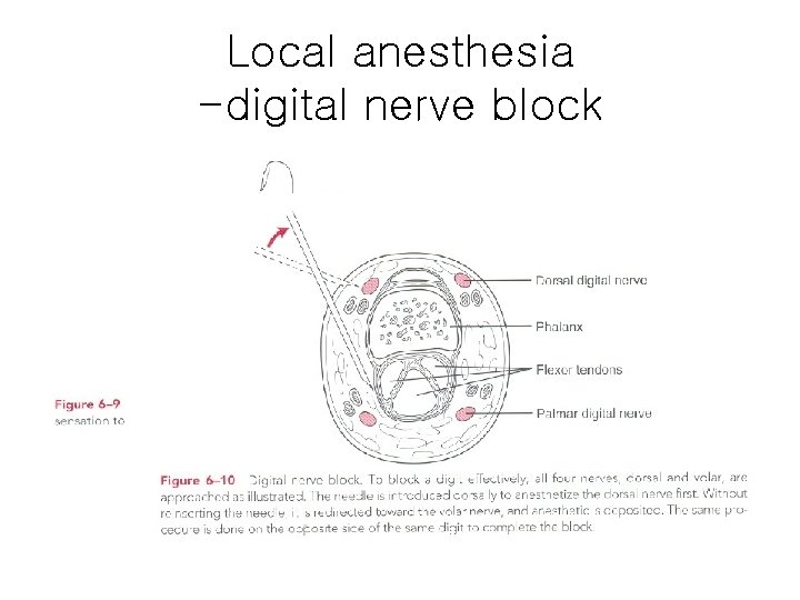 Local anesthesia -digital nerve block Local anesthesia -digital nerve block