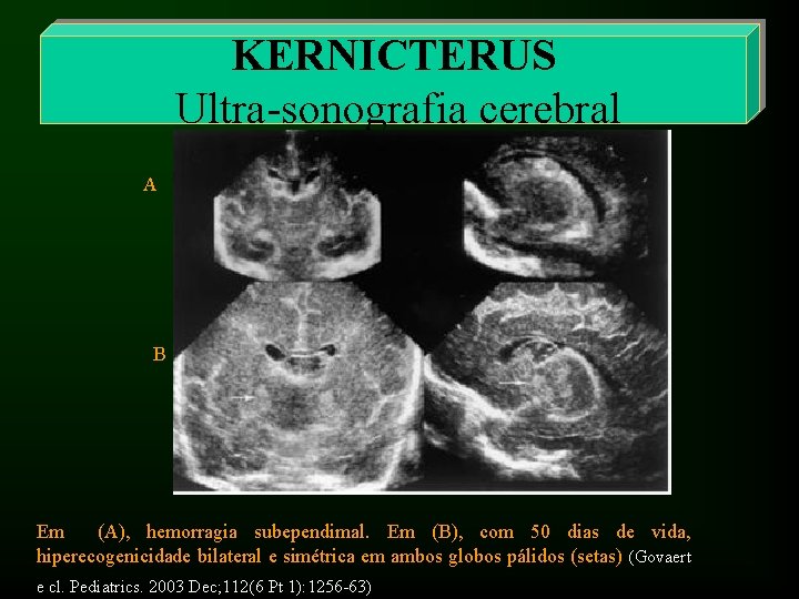 KERNICTERUS Ultra-sonografia cerebral A B Em (A), hemorragia subependimal. Em (B), com 50 dias