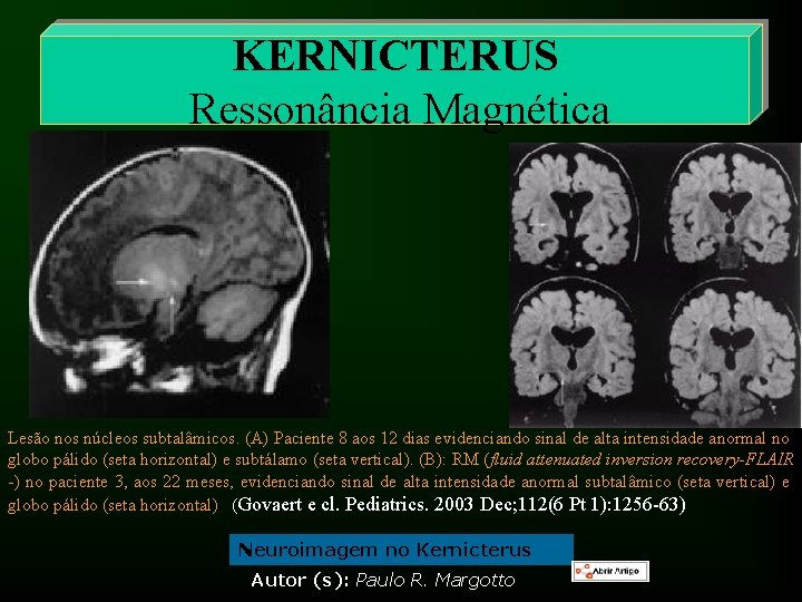 KERNICTERUS Ressonância Magnética Lesão nos núcleos subtalâmicos. (A) Paciente 8 aos 12 dias evidenciando