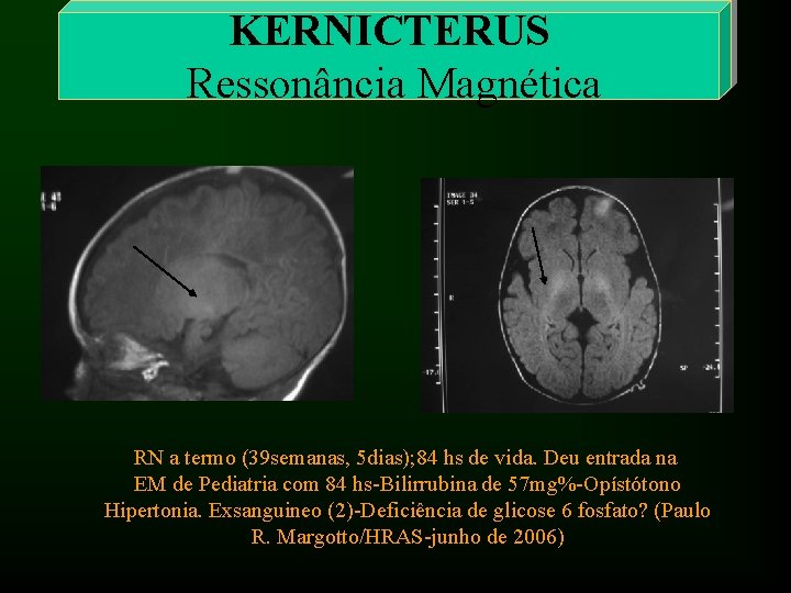 KERNICTERUS Ressonância Magnética RN a termo (39 semanas, 5 dias); 84 hs de vida.
