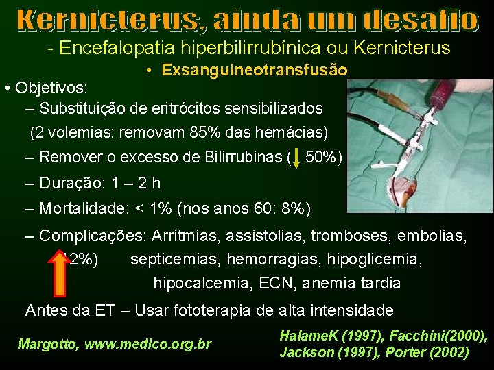 - Encefalopatia hiperbilirrubínica ou Kernicterus • Exsanguineotransfusão • Objetivos: – Substituição de eritrócitos sensibilizados