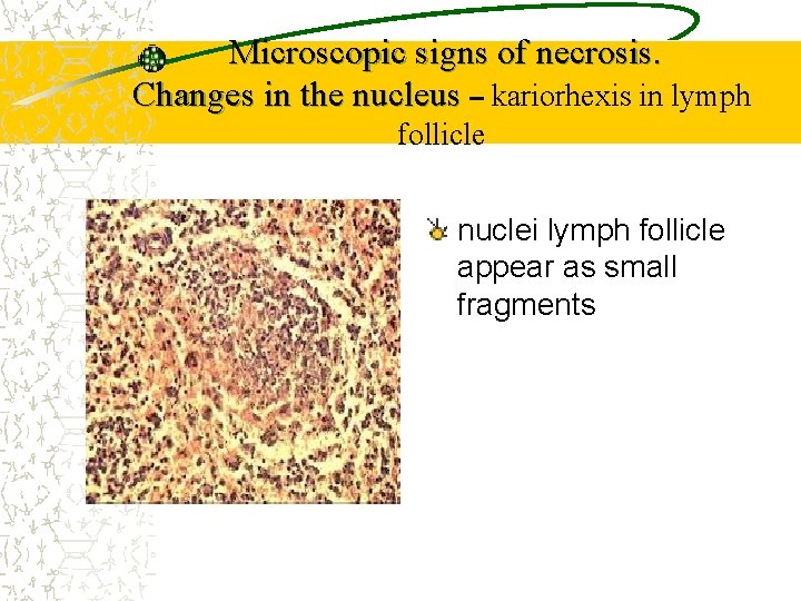 Microscopic signs of necrosis. Changes in the nucleus – kariorhexis in lymph follicle nuclei