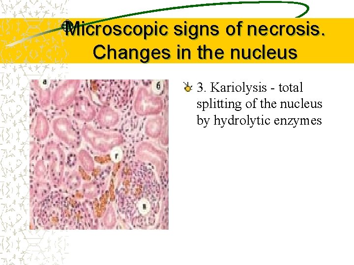 Microscopic signs of necrosis. Changes in the nucleus 3. Kariolysis - total splitting of