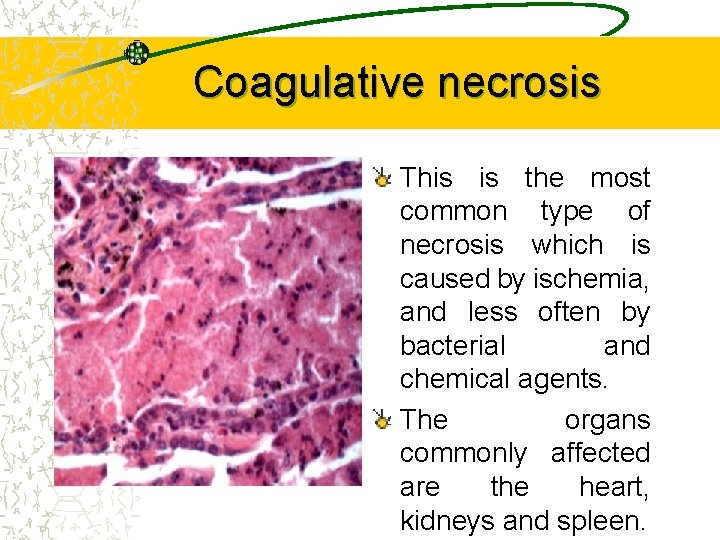 Coagulative necrosis This is the most common type of necrosis which is caused by