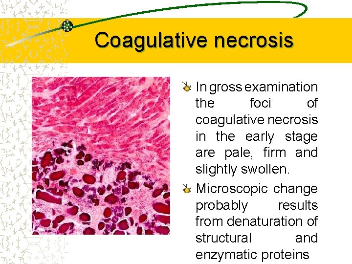 Coagulative necrosis In gross examination the foci of coagulative necrosis in the early stage