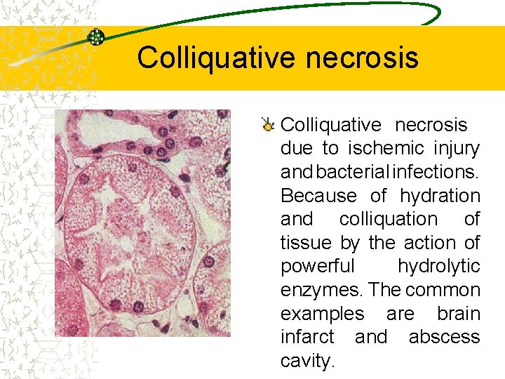 Colliquative necrosis due to ischemic injury and bacterial infections. Because of hydration and colliquation
