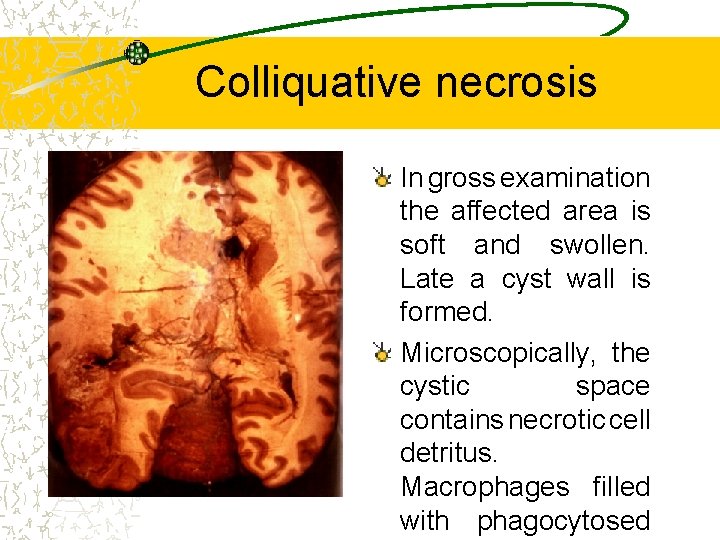 Colliquative necrosis In gross examination the affected area is soft and swollen. Late a