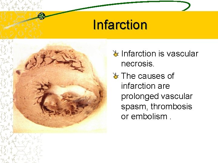 Infarction is vascular necrosis. The causes of infarction are prolonged vascular spasm, thrombosis or