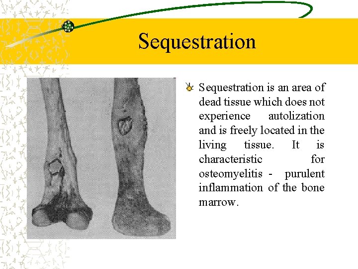 Sequestration is an area of dead tissue which does not experience autolization and is