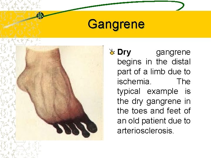 Gangrene Dry gangrene begins in the distal part of a limb due to ischemia.