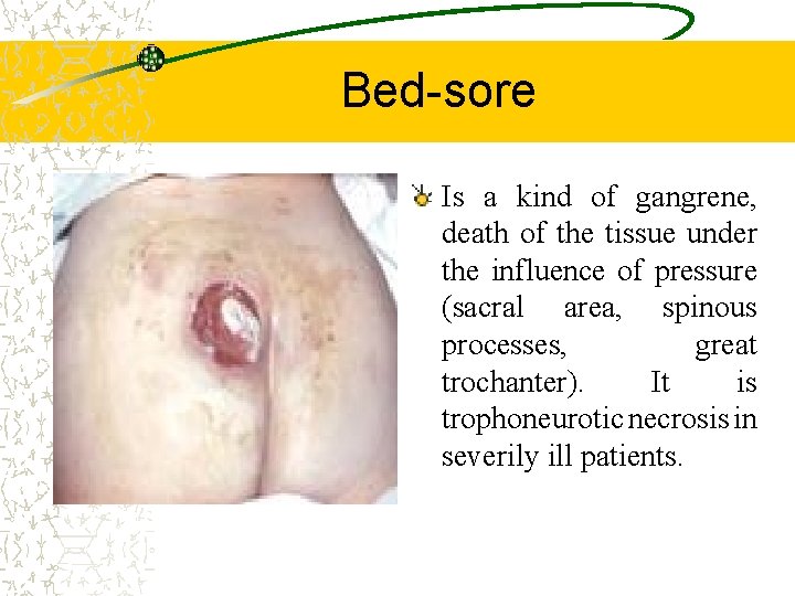 Bed-sore Is a kind of gangrene, death of the tissue under the influence of