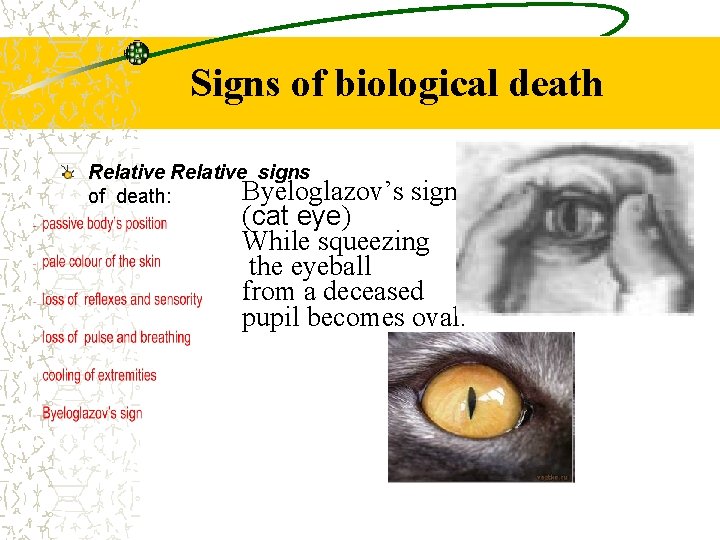 Signs of biological death Relative signs Byeloglazov’s of death: sign (cat eye) While squeezing