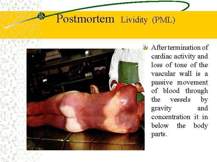 Postmortem Lividity (PML) After termination of cardiac activity and loss of tone of the