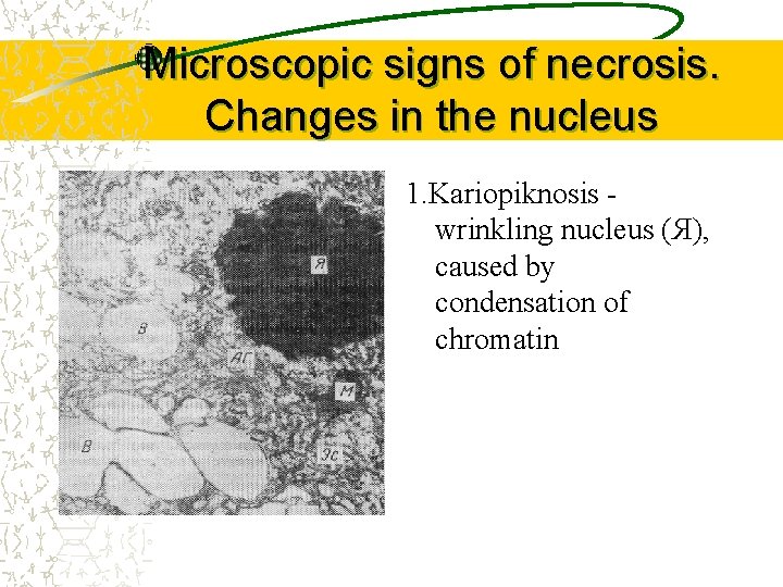 Microscopic signs of necrosis. Changes in the nucleus 1. Kariopiknosis wrinkling nucleus (Я), caused