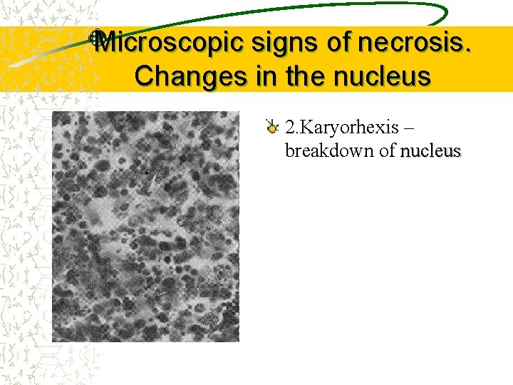 Microscopic signs of necrosis. Changes in the nucleus 2. Karyorhexis – breakdown of nucleus