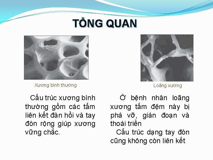 TỔNG QUAN Xương bình thường Cấu trúc xương bình thường gồm các tấm liên