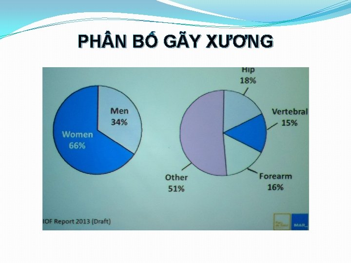 PH N BỐ GÃY XƯƠNG 