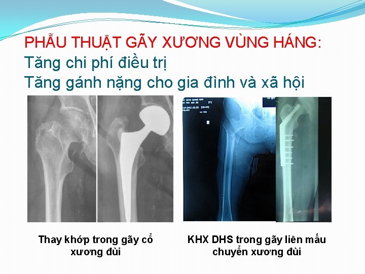 PHẪU THUẬT GÃY XƯƠNG VÙNG HÁNG: Tăng chi phí điều trị Tăng gánh nặng