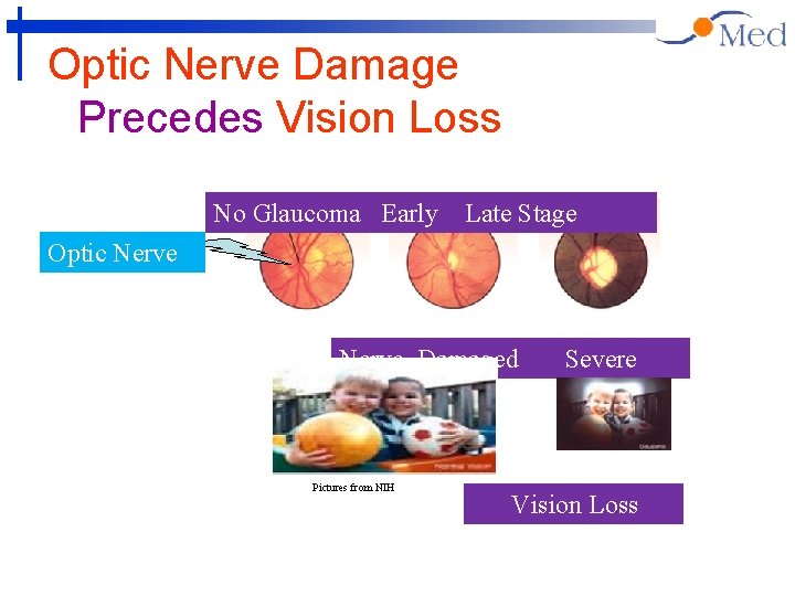 Optic Nerve Damage Precedes Vision Loss No Glaucoma Early Late Stage Optic Nerve Damaged