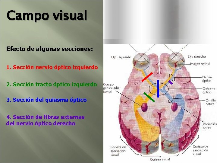 Campo visual Efecto de algunas secciones: 1. Sección nervio óptico izquierdo 2. Sección tracto Campo visual Efecto de algunas secciones: 1. Sección nervio óptico izquierdo 2. Sección tracto