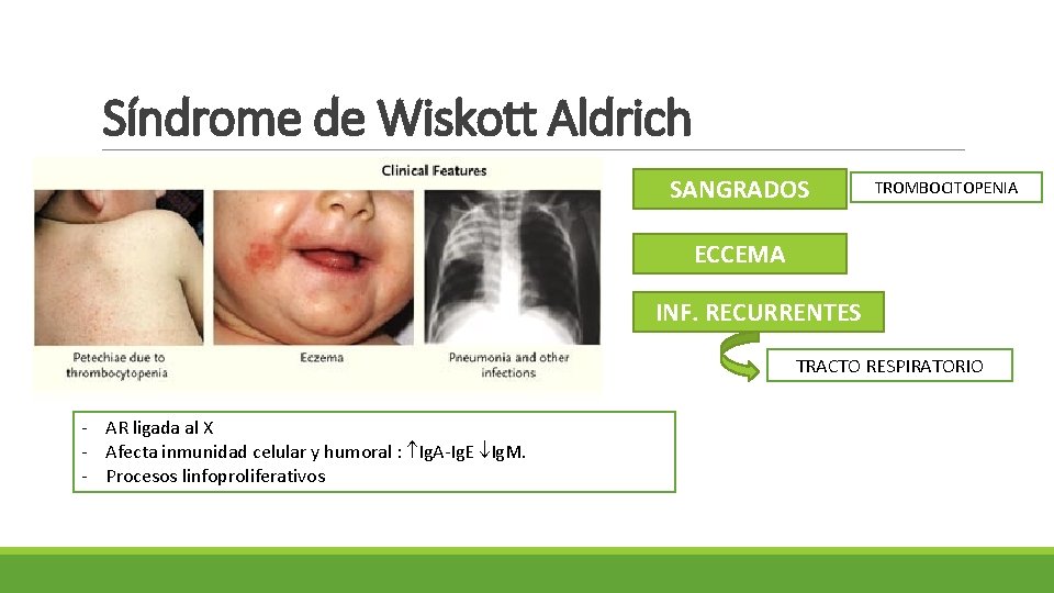 Síndrome de Wiskott Aldrich SANGRADOS TROMBOCITOPENIA ECCEMA INF. RECURRENTES TRACTO RESPIRATORIO ‐ AR ligada
