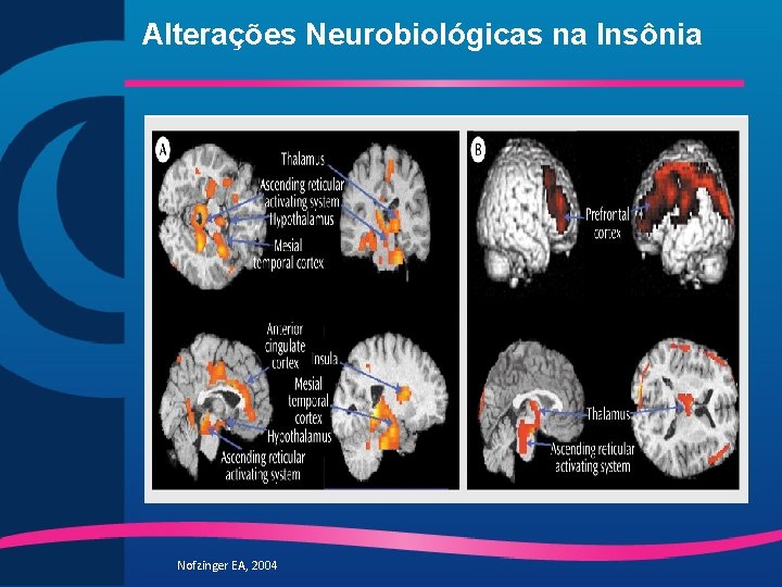 Alterações Neurobiológicas na Insônia Nofzinger EA, 2004 