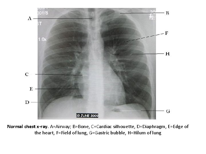 Normal chest x-ray. A=Airway; B=Bone, C=Cardiac silhouette, D=Diaphragm, E=Edge of the heart, F=Field of