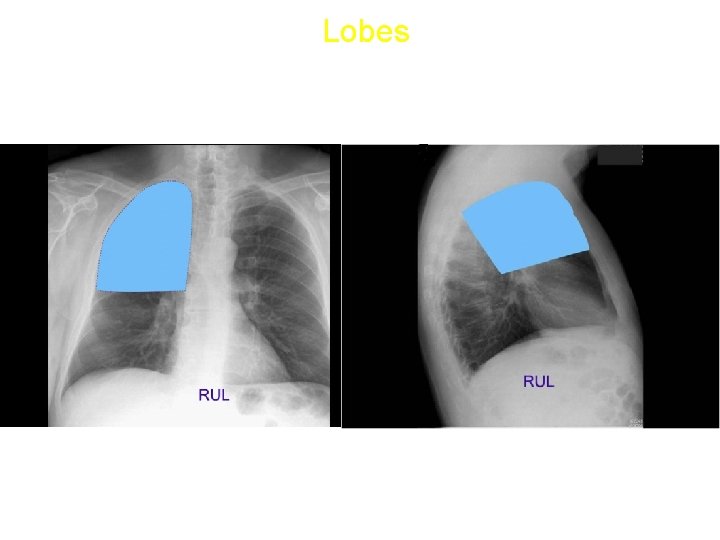 Lobes • Right upper lobe: 