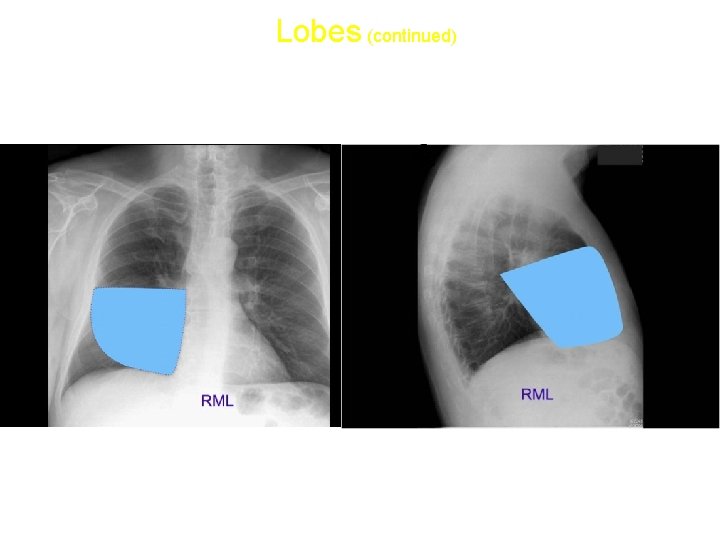 Lobes (continued) • Right middle lobe: 