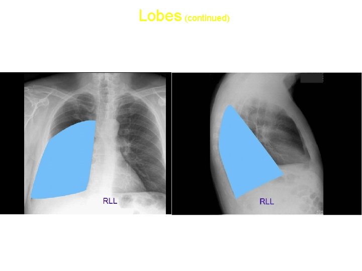Lobes (continued) • Right lower lobe: 