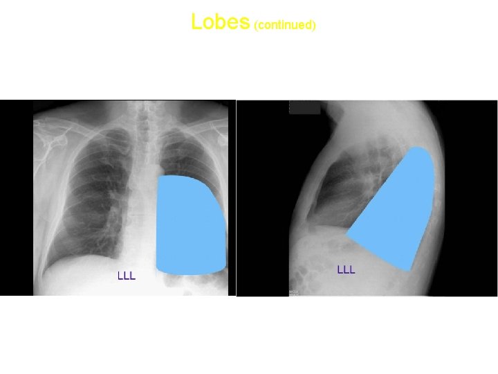 Lobes (continued) • Left lower lobe: 