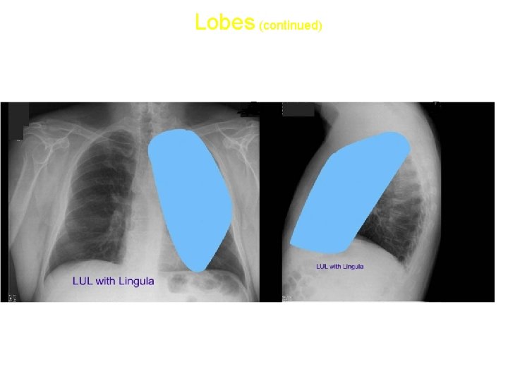 Lobes (continued) • Left upper lobe with Lingula: 