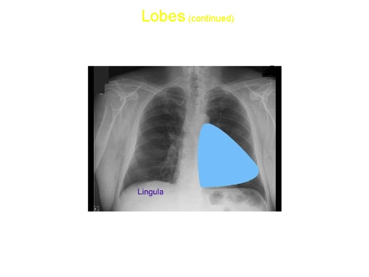 Lobes (continued) • Lingula: 