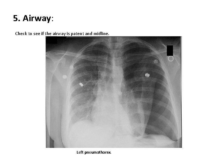 5. Airway: Check to see if the airway is patent and midline. Left pneumothorax.