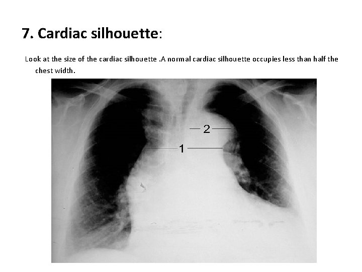 7. Cardiac silhouette: Look at the size of the cardiac silhouette. A normal cardiac