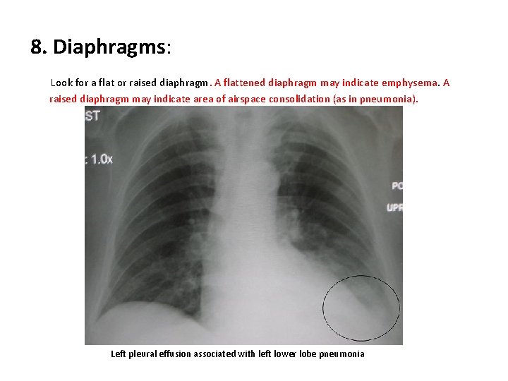 8. Diaphragms: Look for a flat or raised diaphragm. A flattened diaphragm may indicate