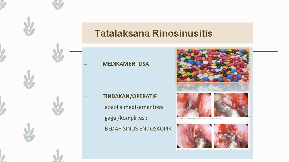 Tatalaksana Rinosinusitis – MEDIKAMENTOSA – TINDAKAN/OPERATIF apabila medikamentosa gagal/komplikasi: BEDAH SINUS ENDOSKOPIK 