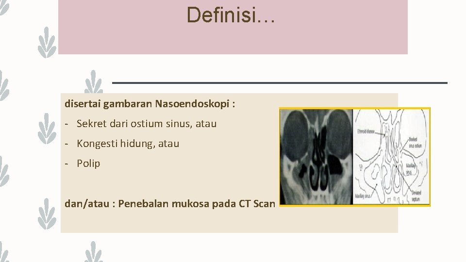 Definisi… disertai gambaran Nasoendoskopi : - Sekret dari ostium sinus, atau - Kongesti hidung,