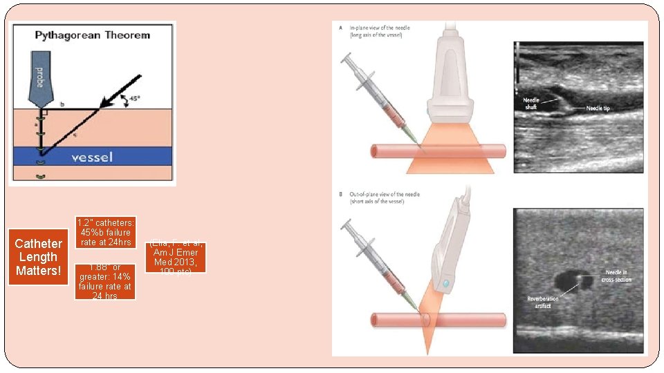 Catheter Length Matters! 1. 2” catheters: 45%b failure rate at 24 hrs 1. 88”
