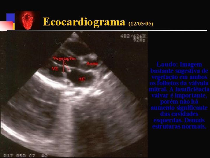 Ecocardiograma (12/05/05) Laudo: Imagem bastante sugestiva de vegetação em ambos os folhetos da válvula