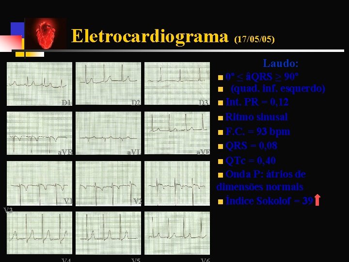 Eletrocardiograma (17/05/05) Laudo: V 3 D 1 D 2 D 3 a. VR a.