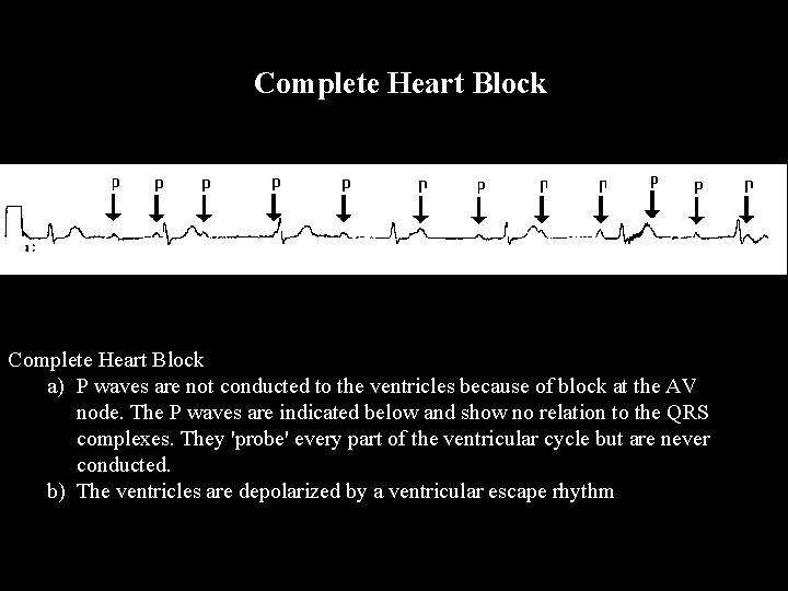  Complete Heart Block a) P waves are not conducted to the ventricles because