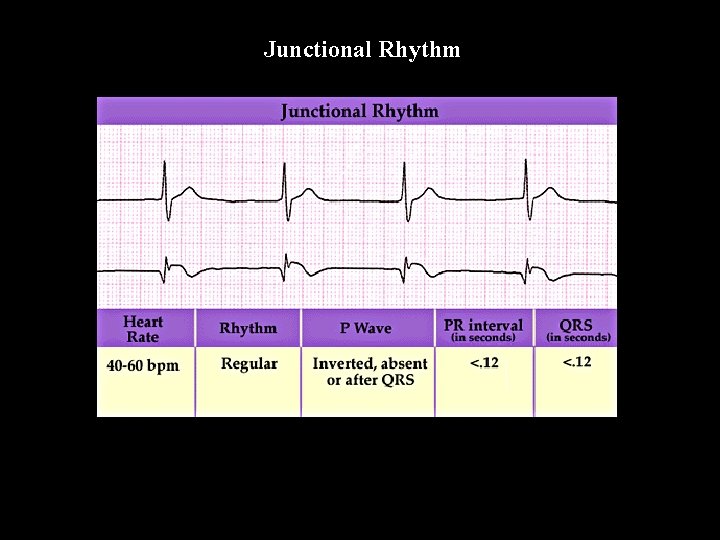 Junctional Rhythm 