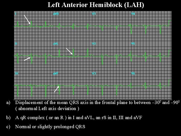 Left Anterior Hemiblock (LAH) a) Displacement of the mean QRS axis in the frontal