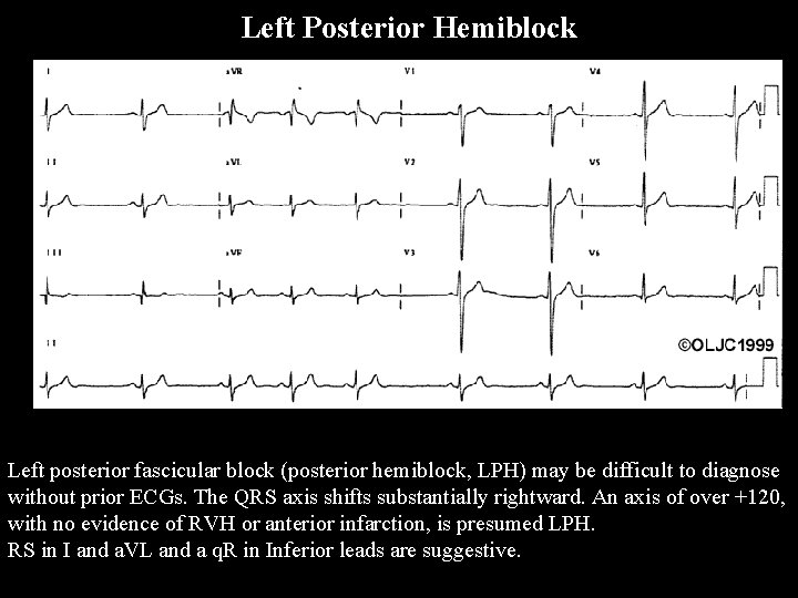 Left Posterior Hemiblock Left posterior fascicular block (posterior hemiblock, LPH) may be difficult to