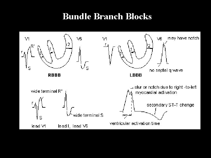 Bundle Branch Blocks 