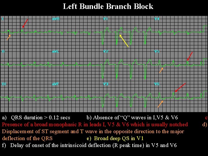 Left Bundle Branch Block a) QRS duration > 0. 12 secs b) Absence of