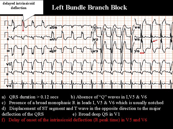 delayed intrinsicoid deflection Left Bundle Branch Block a) QRS duration > 0. 12 secs